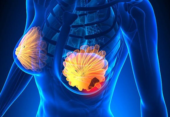 Incidencia global de cáncer en mujeres